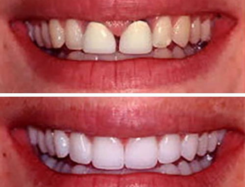 روکش تمام سرامیک