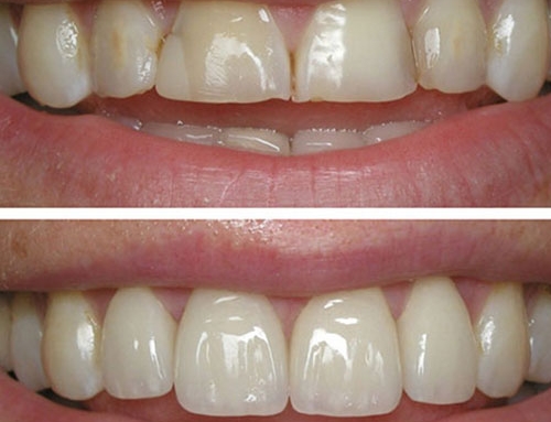 روکش تمام سرامیک ۲