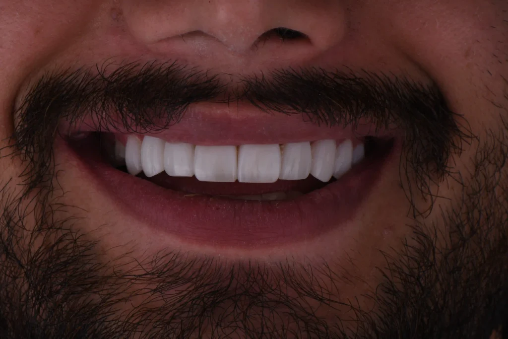 لبخندی طبیعی‌تر بیمار